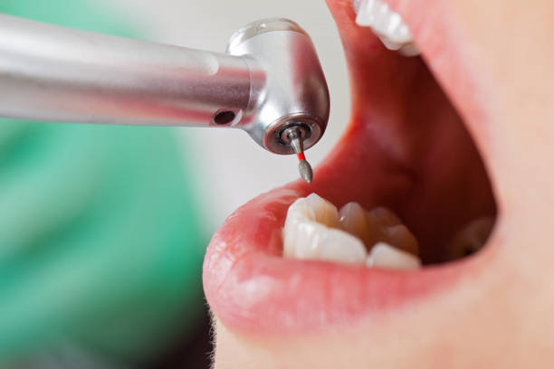 Best Emergency Wisdom Teeth Removal in Westminster, TX